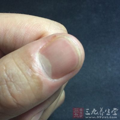 指甲出現(xiàn)白點(diǎn)或絮狀白斑 指甲出現(xiàn)白點(diǎn)或絮狀白斑